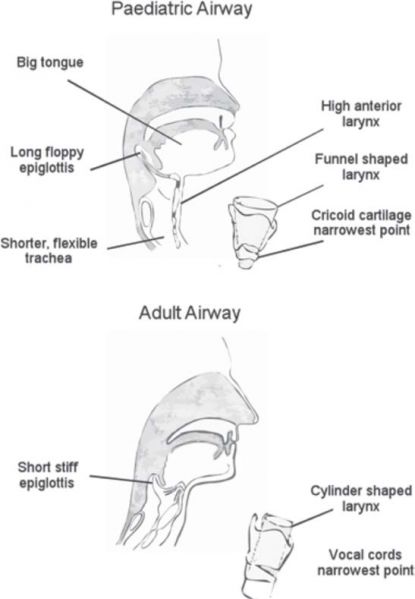 File:Peds vs Adult Airway.jpg