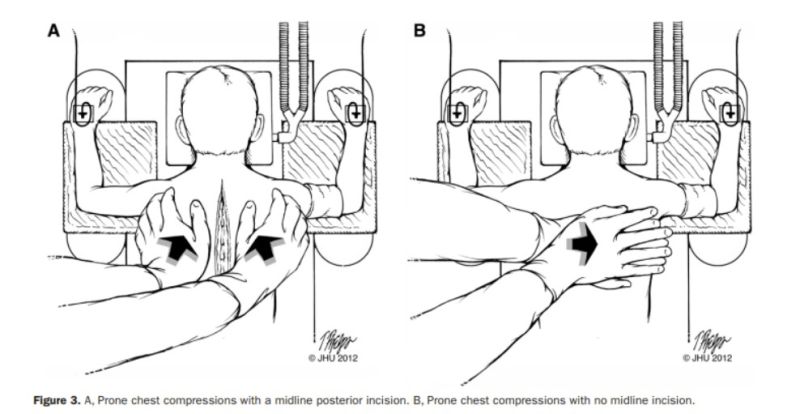 File:Prone Chest Compression.jpg