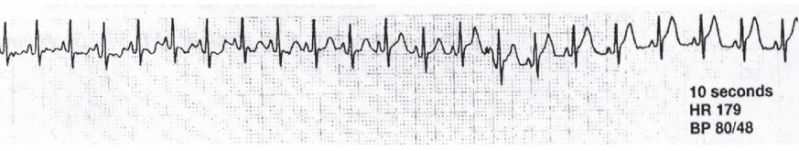 File:Caudal Positive test ECG.jpg
